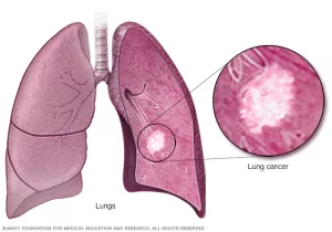 lung cancer