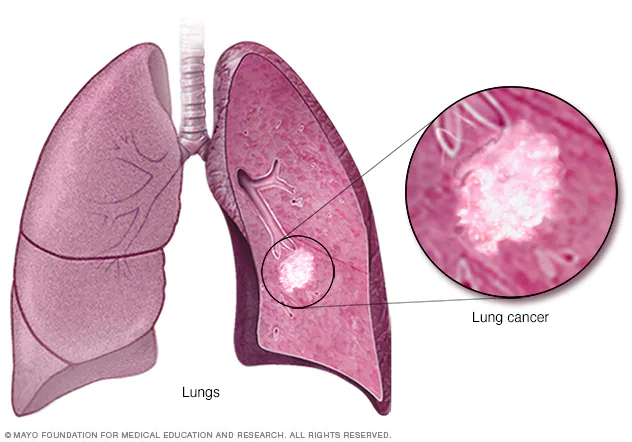 lung cancer